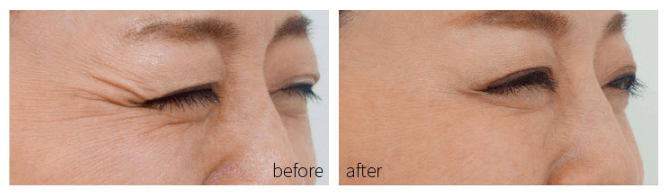 Eye wrinkles before and after use of a beauty LED light face therapy mask