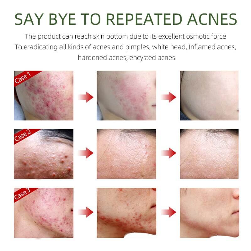 3 cases of women treated with herbal acne removal facial cream - before,during and after usage