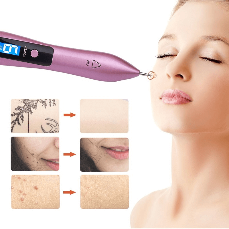 After using the 9-intensity levels blemish remover pen, a flawless and smooth complexion is revealed, effectively eliminating tattoos, moles, and other blemishes from a woman's face.