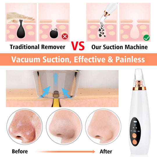 Before and after use of electric rechargable blackhead remover on a human nose 