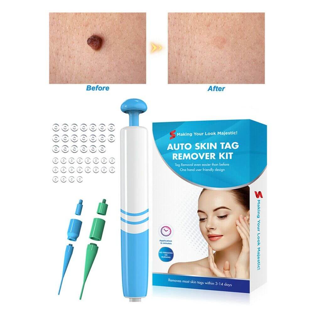 Painless skin wart removal kit -before and after its usage 