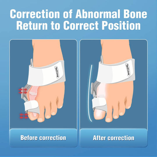 Correction of abnormal bone with adjustable bunion corrector - before and after correction