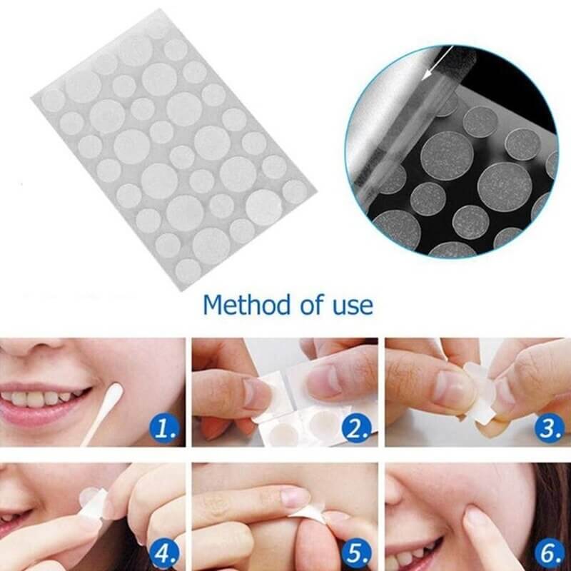 Method of use of acne removal patches