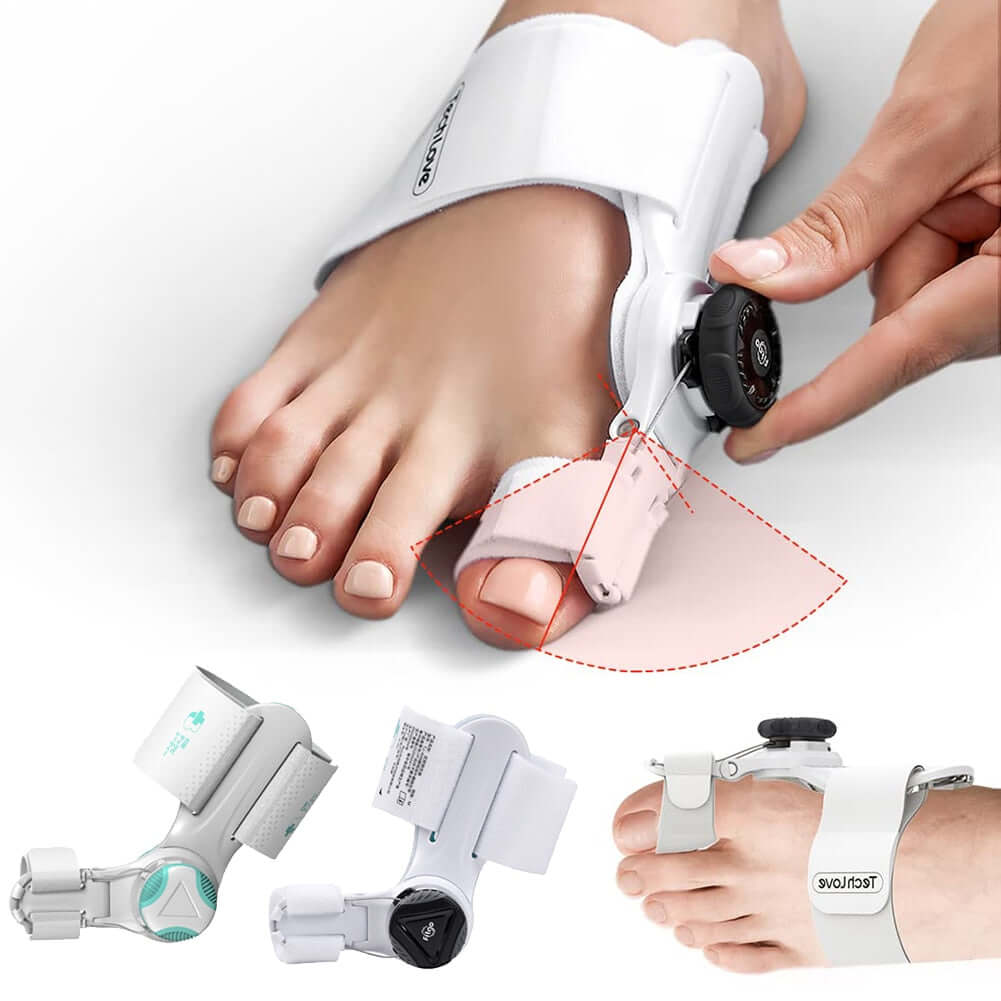 Straightening of the big toe with an adjustable bunion corrector