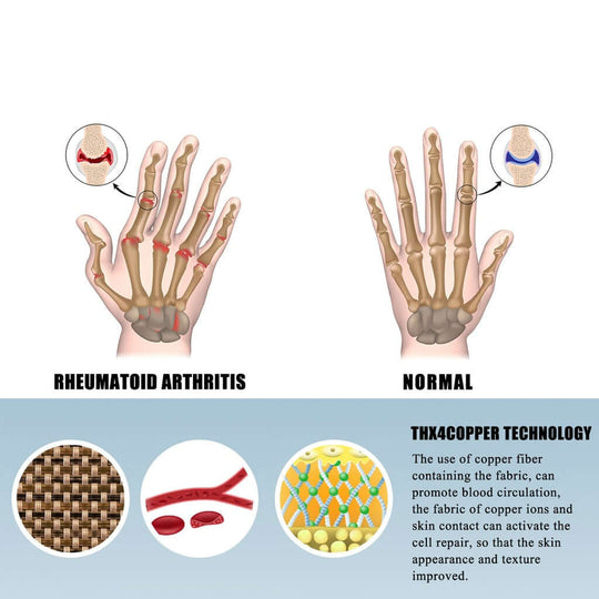 The difference between a normal and reumatoid arthritis hands and the benefits of copper